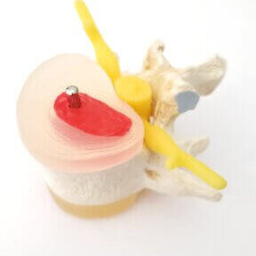 image of a disc bulge