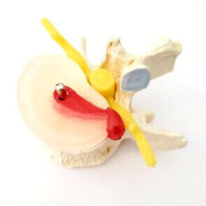 Image of a Disc herniation