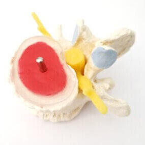 Image of disc sequestration